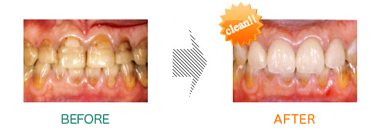 審美歯科：before after