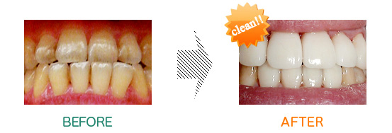 審美歯科：before after