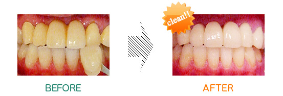 審美歯科：before after