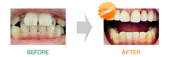 審美歯科：before after